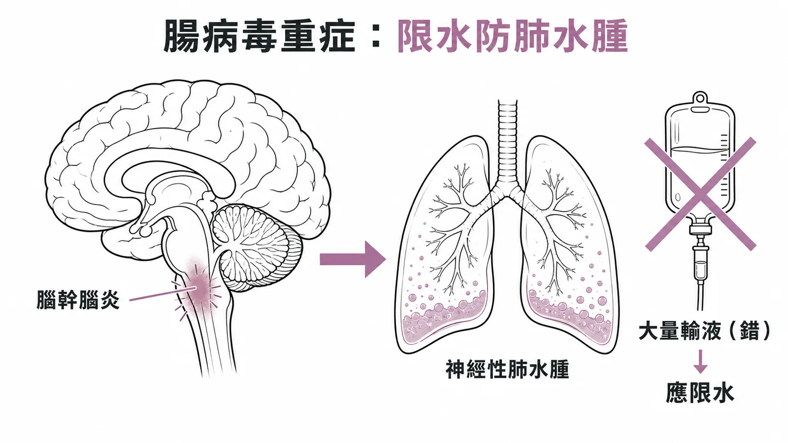 腸病毒重症:腦幹腦炎引發神經性肺水腫,應限水而非大量輸液