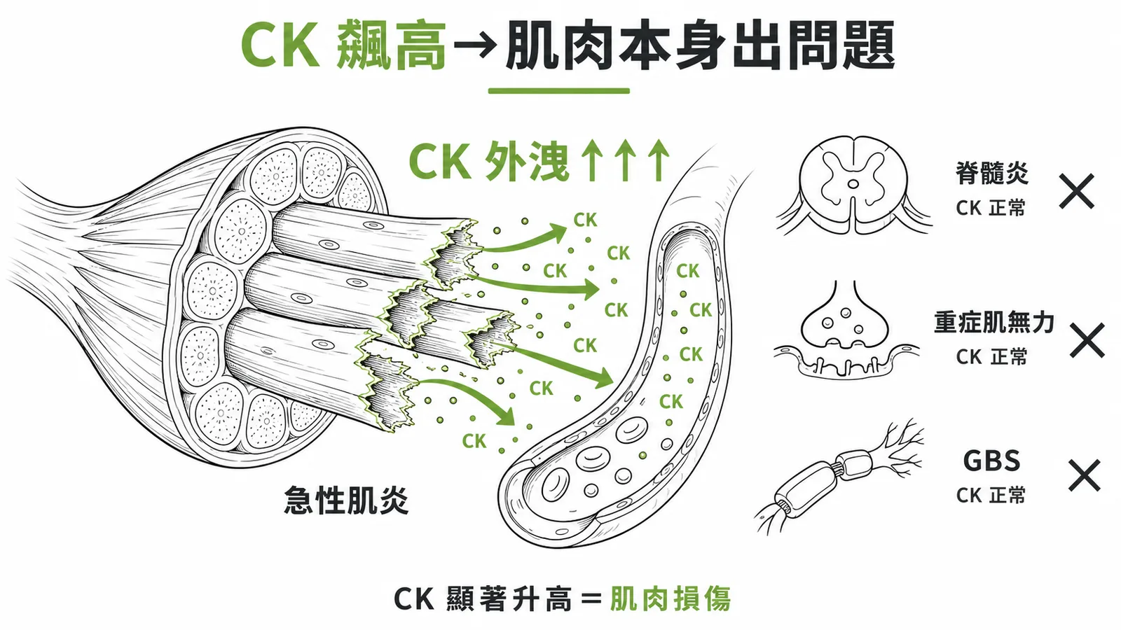CK 顯著升高指向肌肉損傷(急性肌炎),脊髓炎、重症肌無力、GBS 的 CK 皆正常