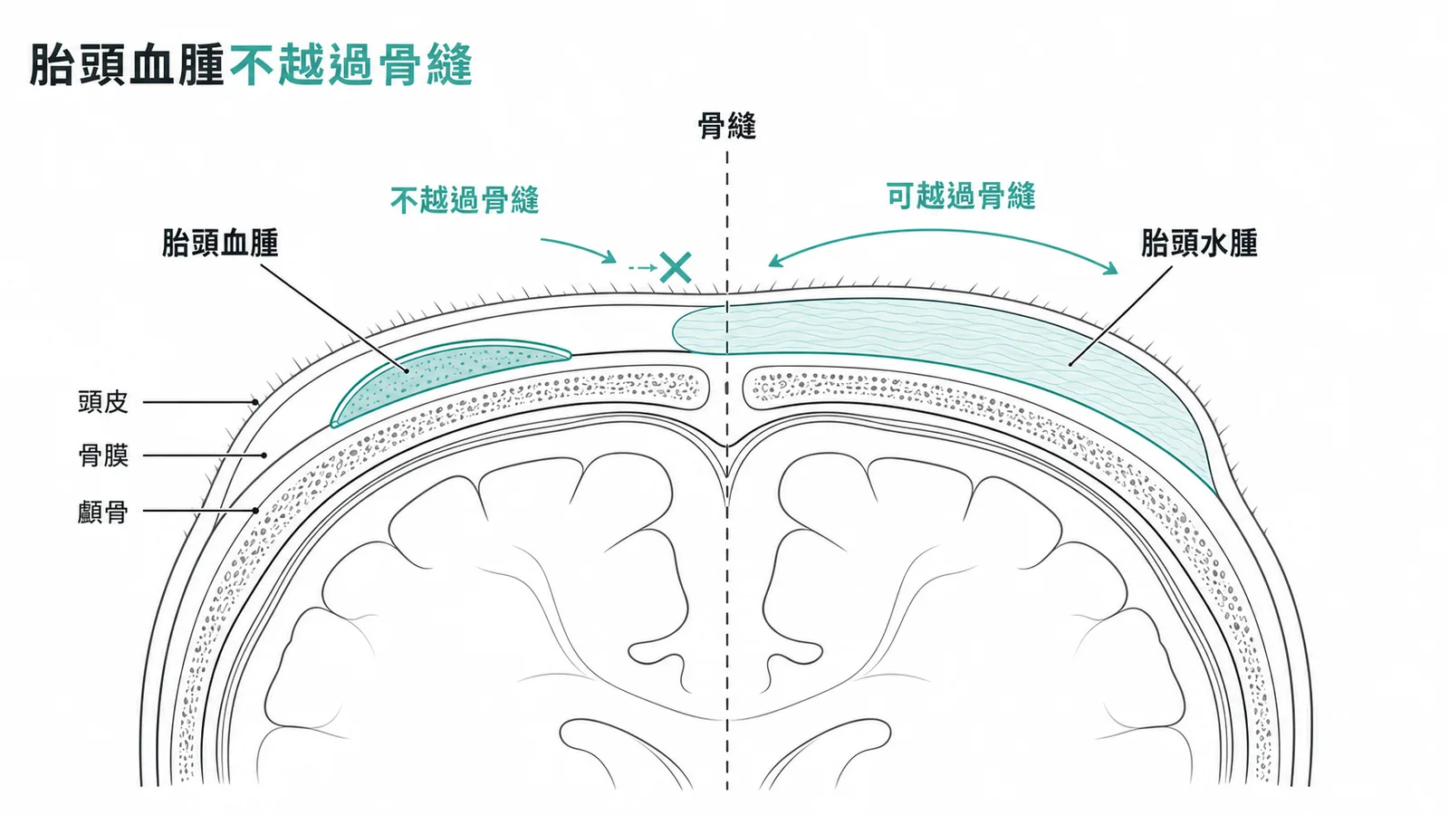 胎頭血腫(骨膜下)不越過骨縫 vs 胎頭水腫(頭皮下)可越過骨縫