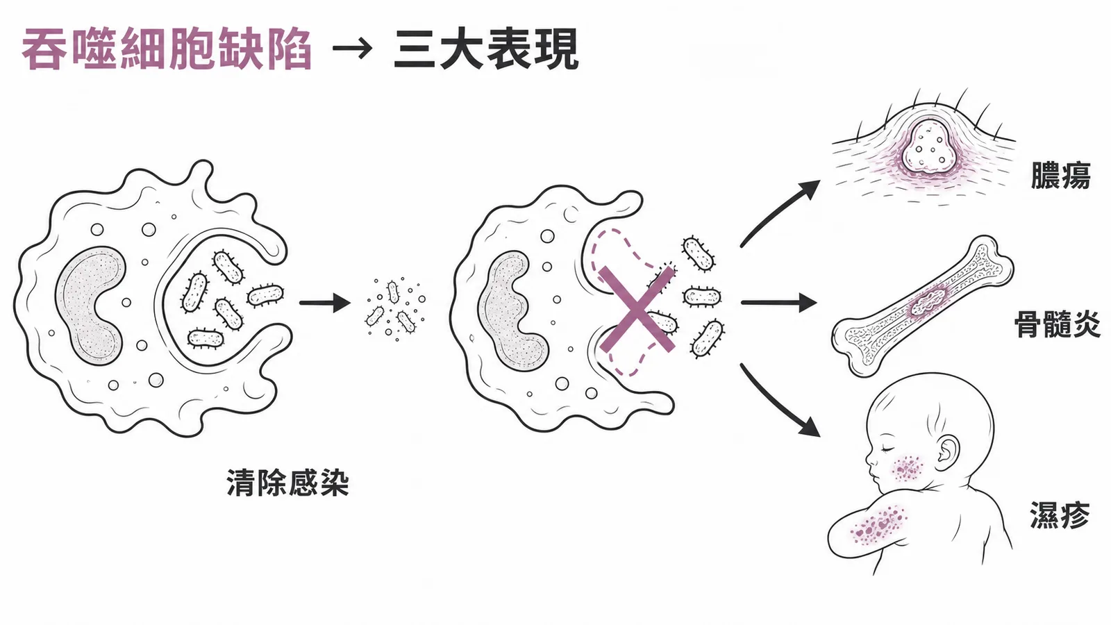 吞噬細胞缺陷與三大臨床表現:膿瘍、骨髓炎、濕疹