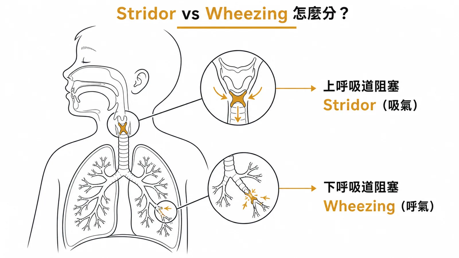 上呼吸道阻塞產生Stridor與下呼吸道阻塞產生Wheezing的差異