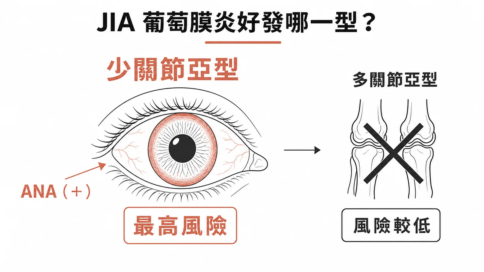 JIA葡萄膜炎好發於少關節亞型且ANA陽性