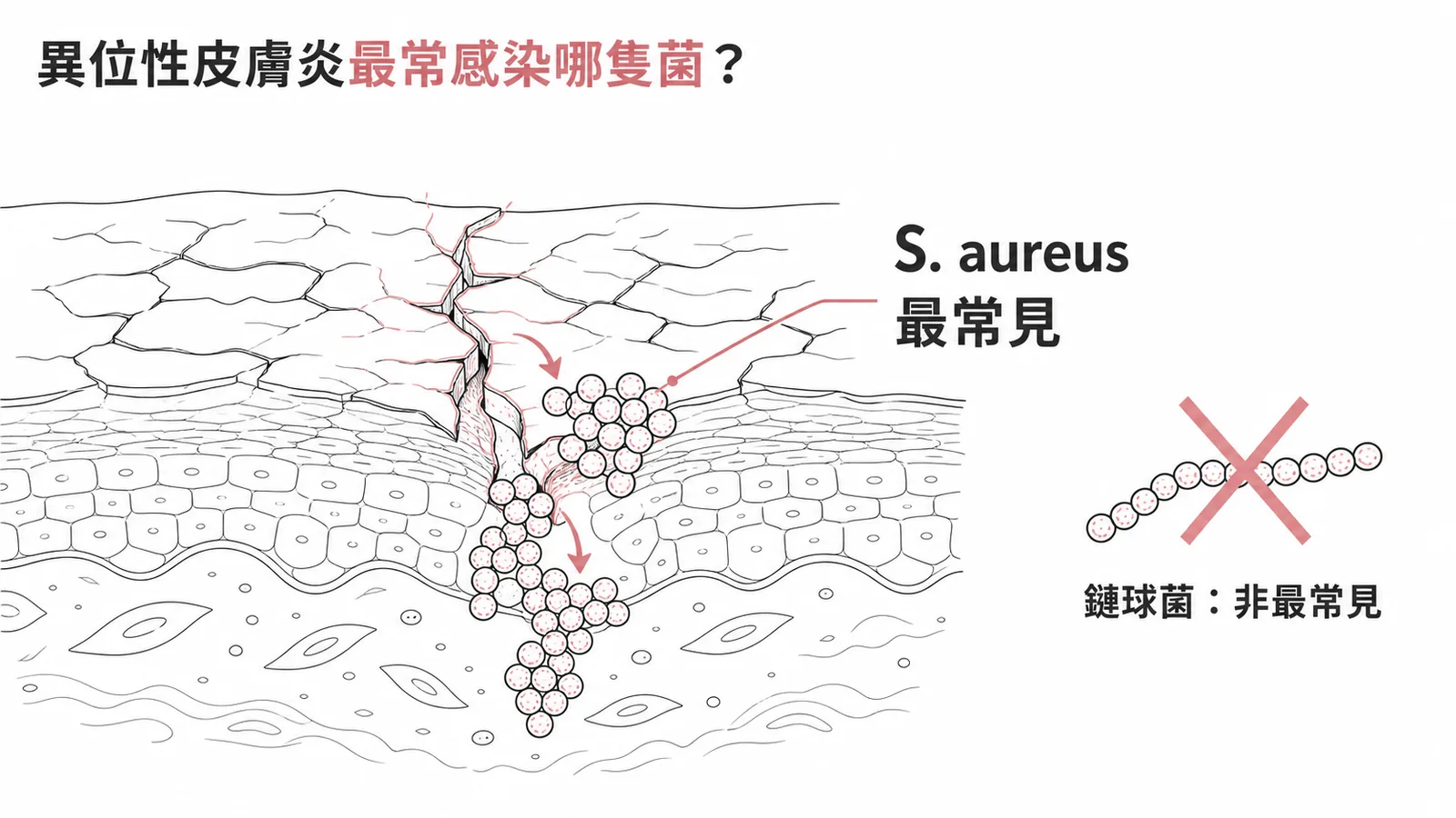 異位性皮膚炎最常合併金黃色葡萄球菌感染