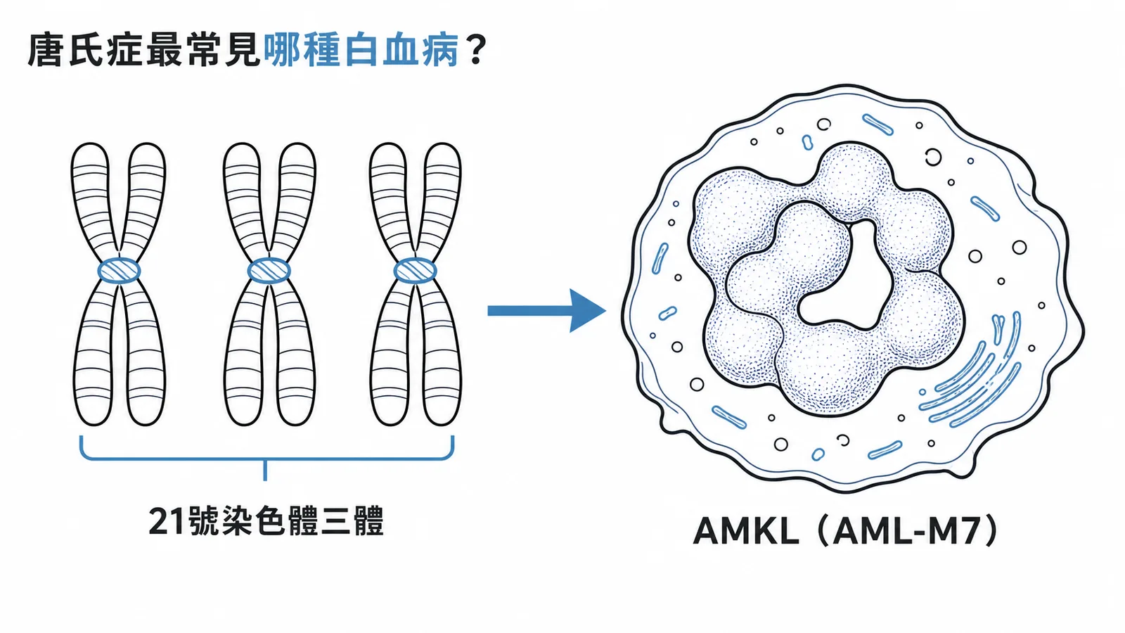 唐氏症Trisomy 21最常合併急性巨核細胞白血病AMKL