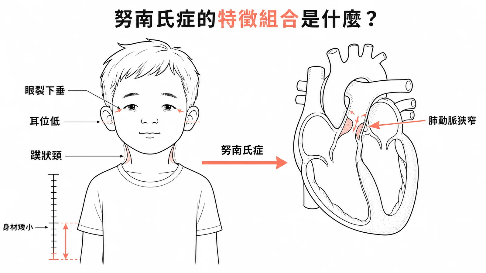 努南氏症特徵組合:眼裂下垂、耳位低、蹼狀頸、矮小與肺動脈狹窄