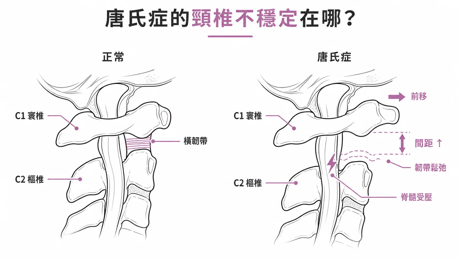 唐氏症C1-C2寰樞椎不穩定:韌帶鬆弛致間距增寬與脊髓受壓