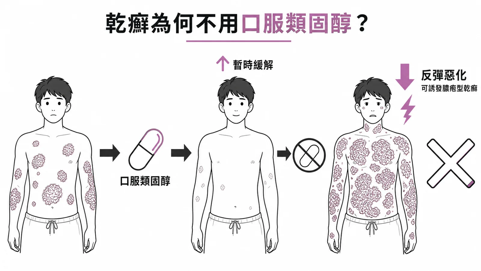 乾癬口服類固醇停藥後反彈惡化的風險