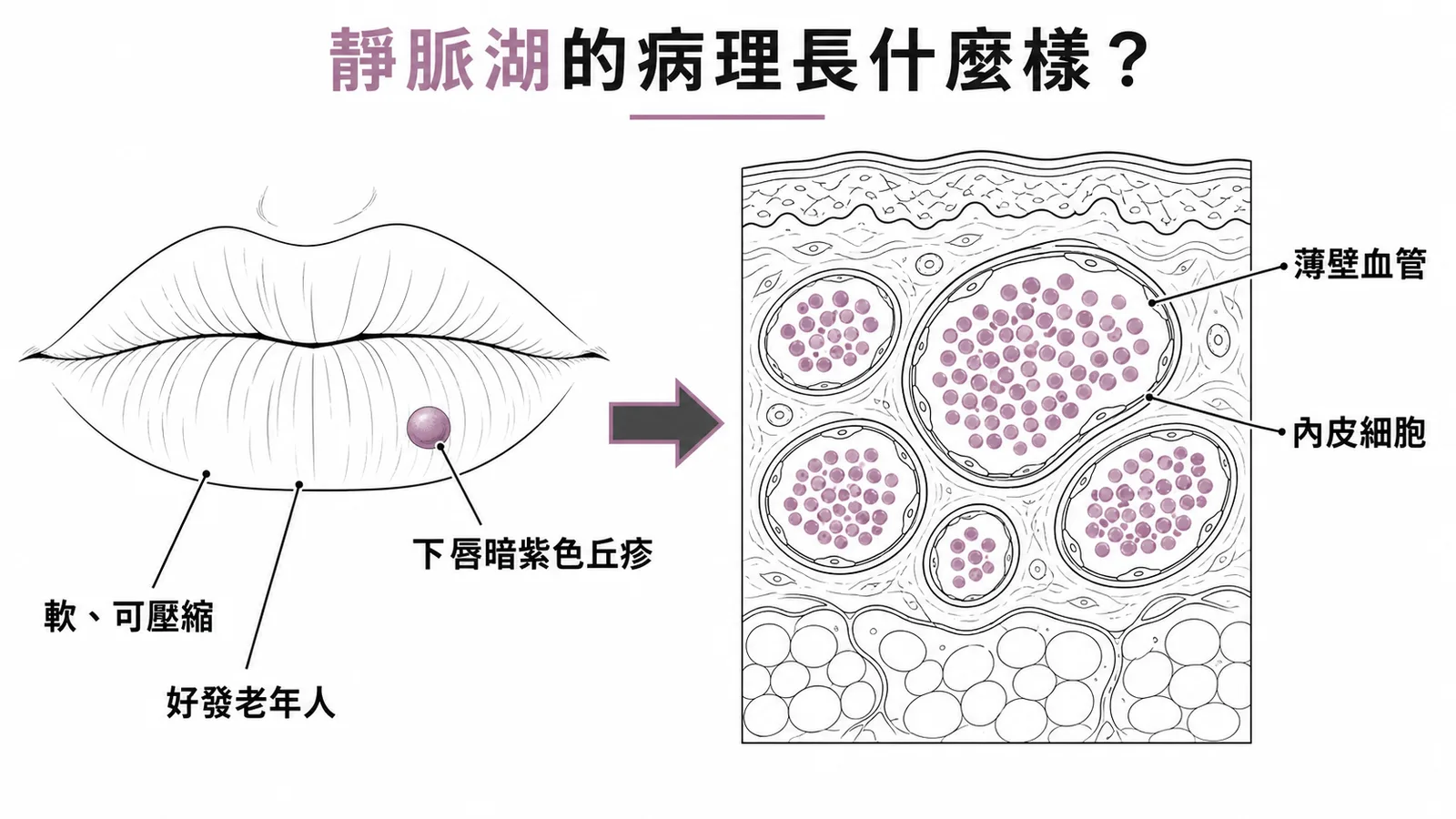 靜脈湖臨床與病理對照：擴張薄壁血管腔充滿紅血球