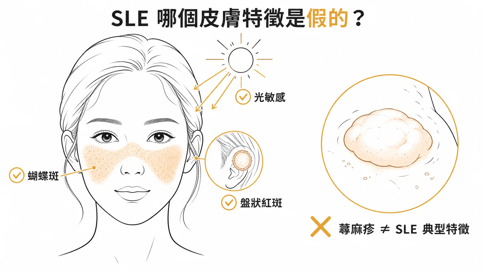 SLE典型皮膚特徵(蝴蝶斑、光敏感、盤狀紅斑)vs蕁麻疹非典型