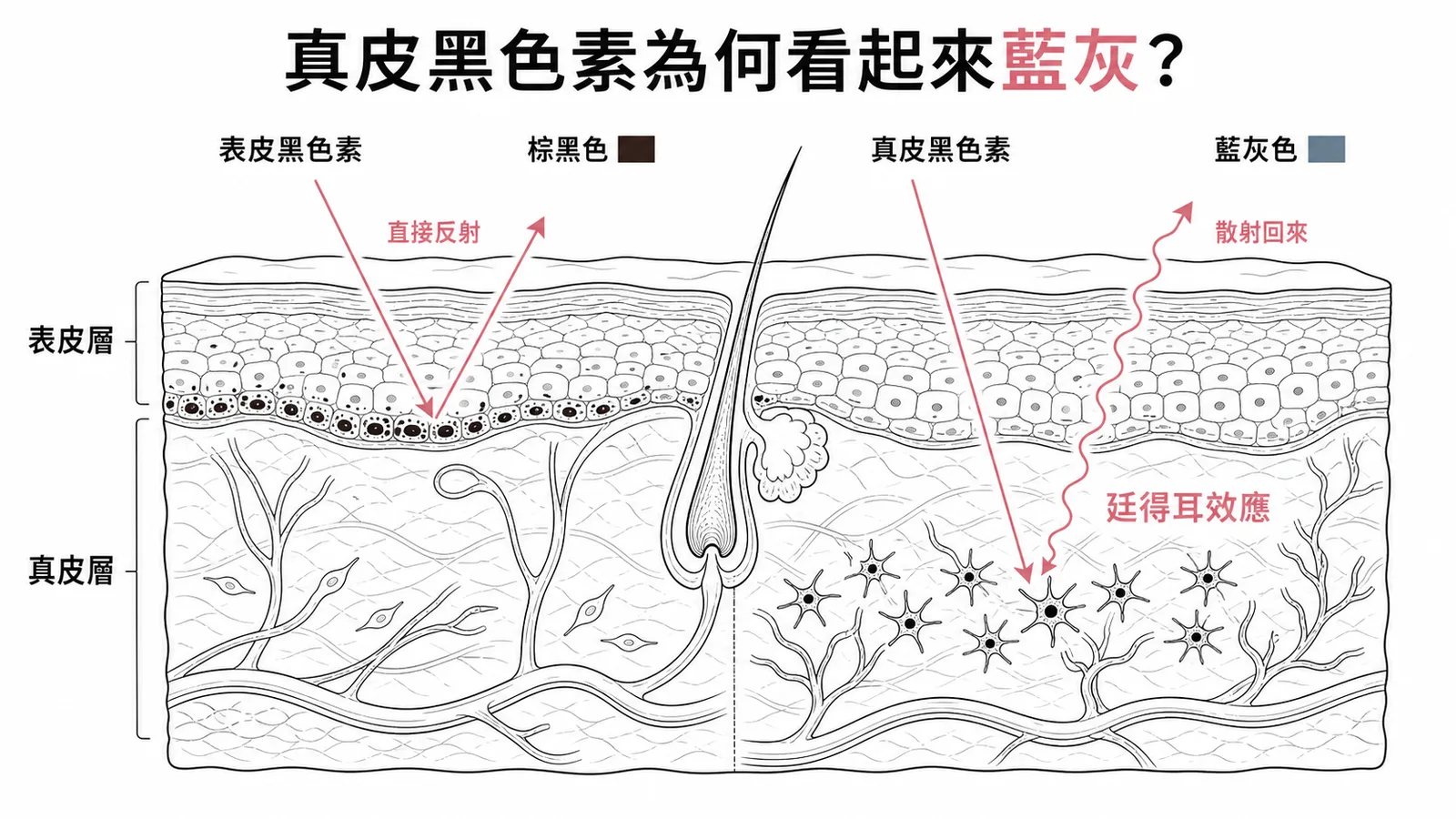 廷得耳效應:表皮黑色素呈棕黑色vs真皮黑色素散射藍光呈藍灰色