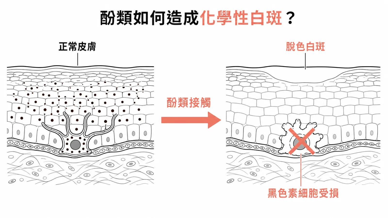 酚類破壞黑色素細胞導致化學性白斑的機轉