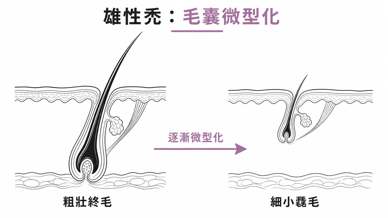 雄性禿毛囊微型化:終毛逐漸變成毳毛