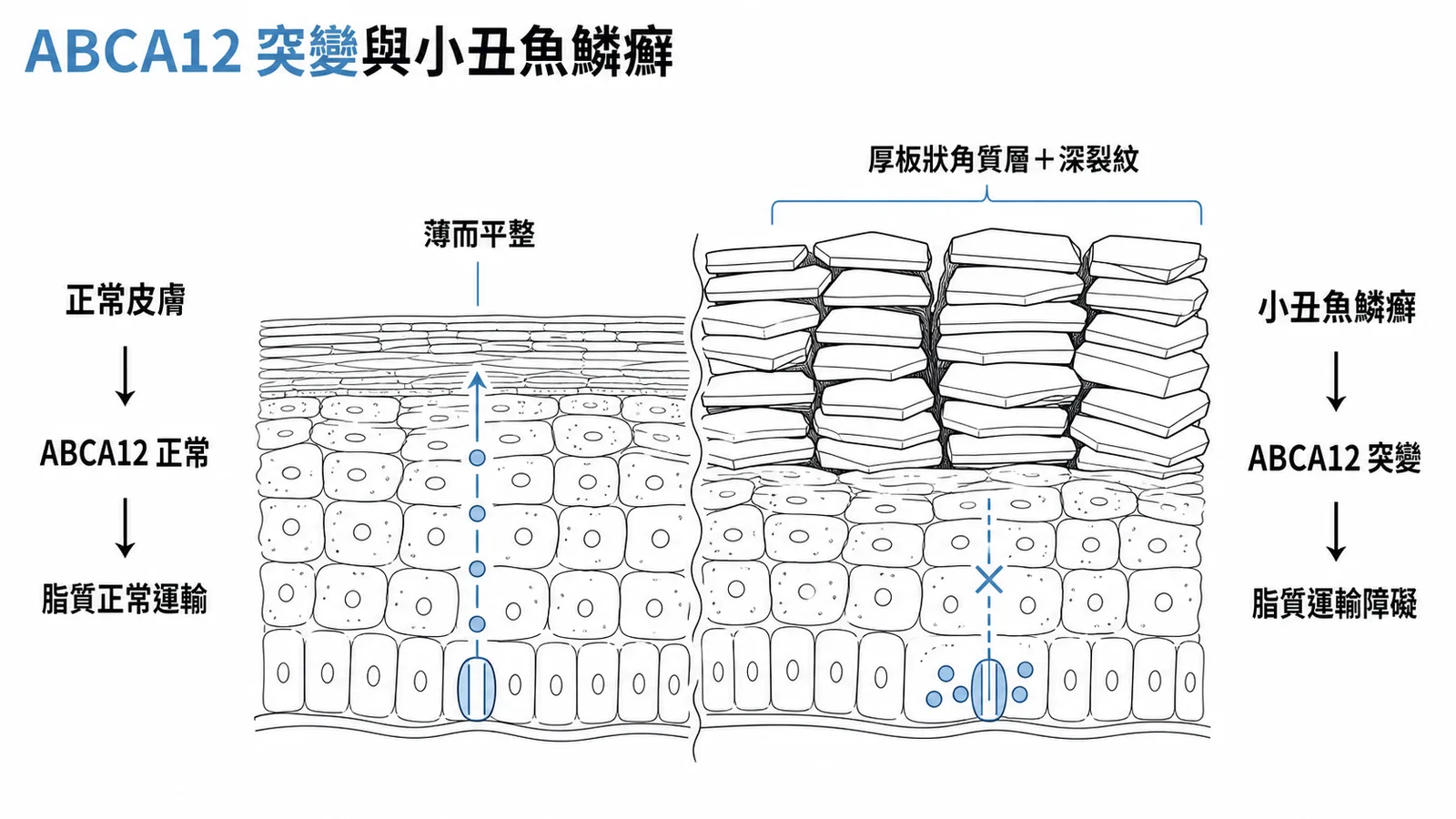 ABCA12基因突變導致角質層異常增厚的機轉