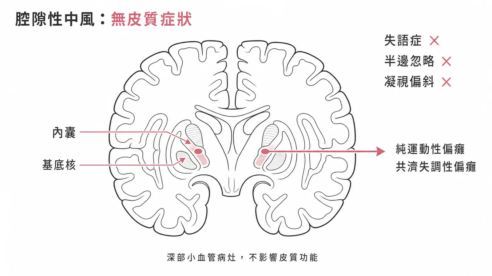 腔隙性中風只影響深部結構不出現皮質症狀