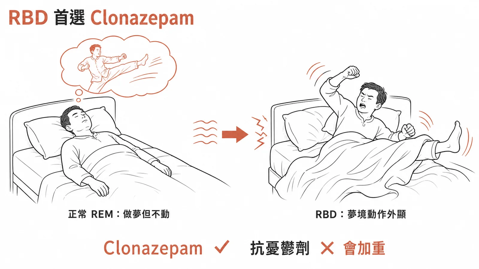 RBD治療首選Clonazepam而非抗憂鬱劑