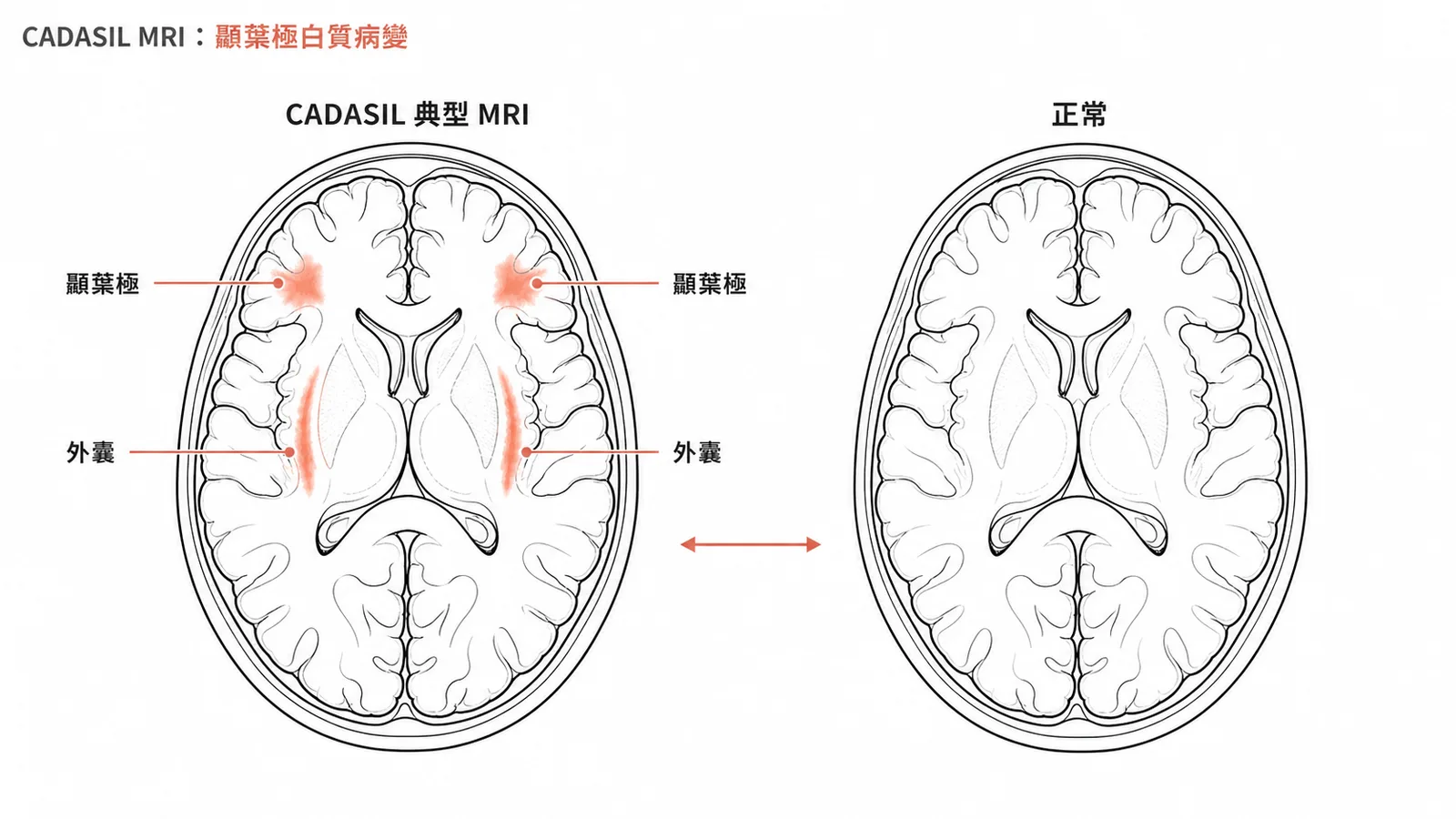 CADASIL 典型 MRI 與正常腦部對照：顳葉極與外囊白質病灶