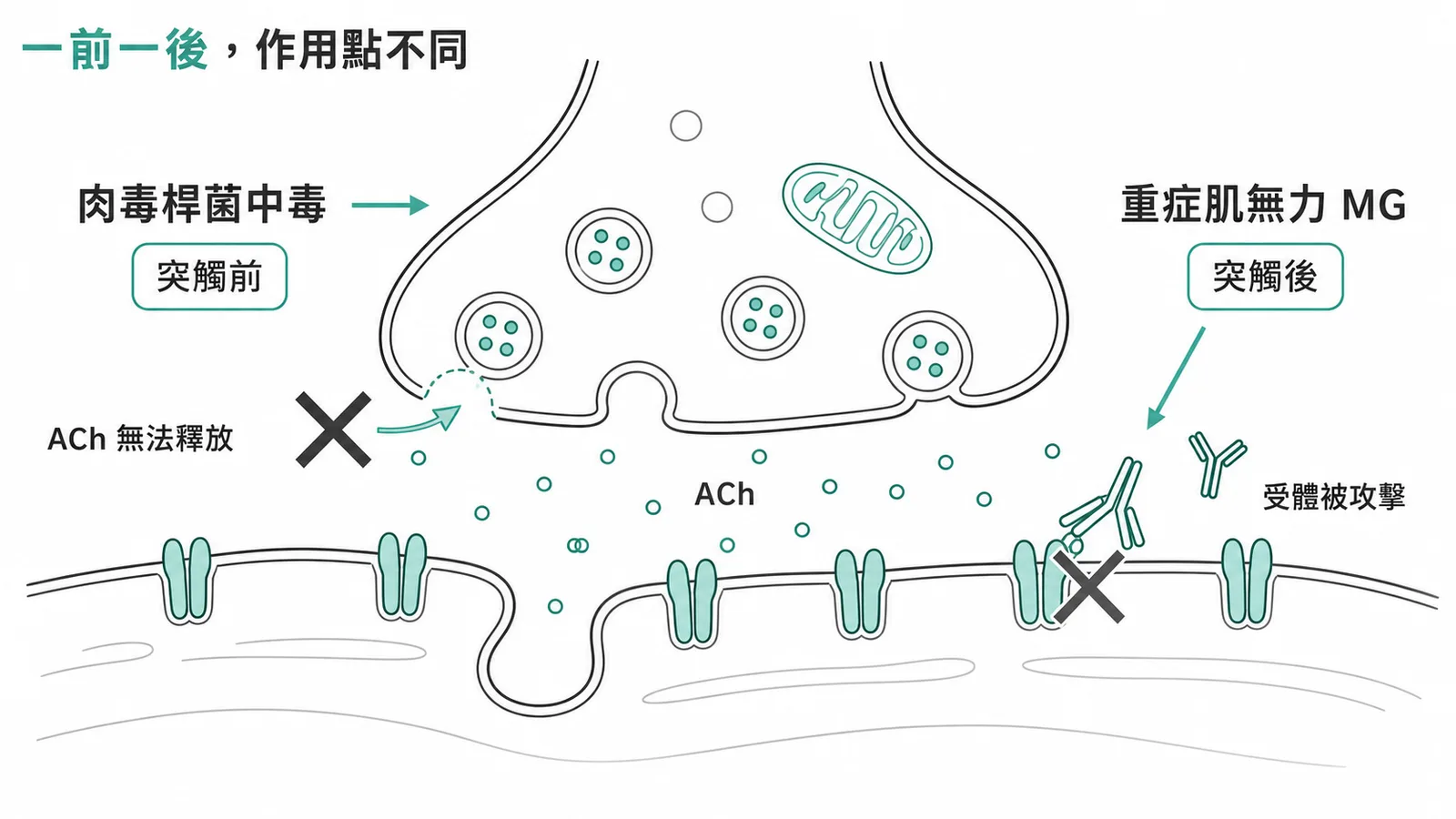 肉毒桿菌中毒與重症肌無力的神經肌肉接合處作用點比較