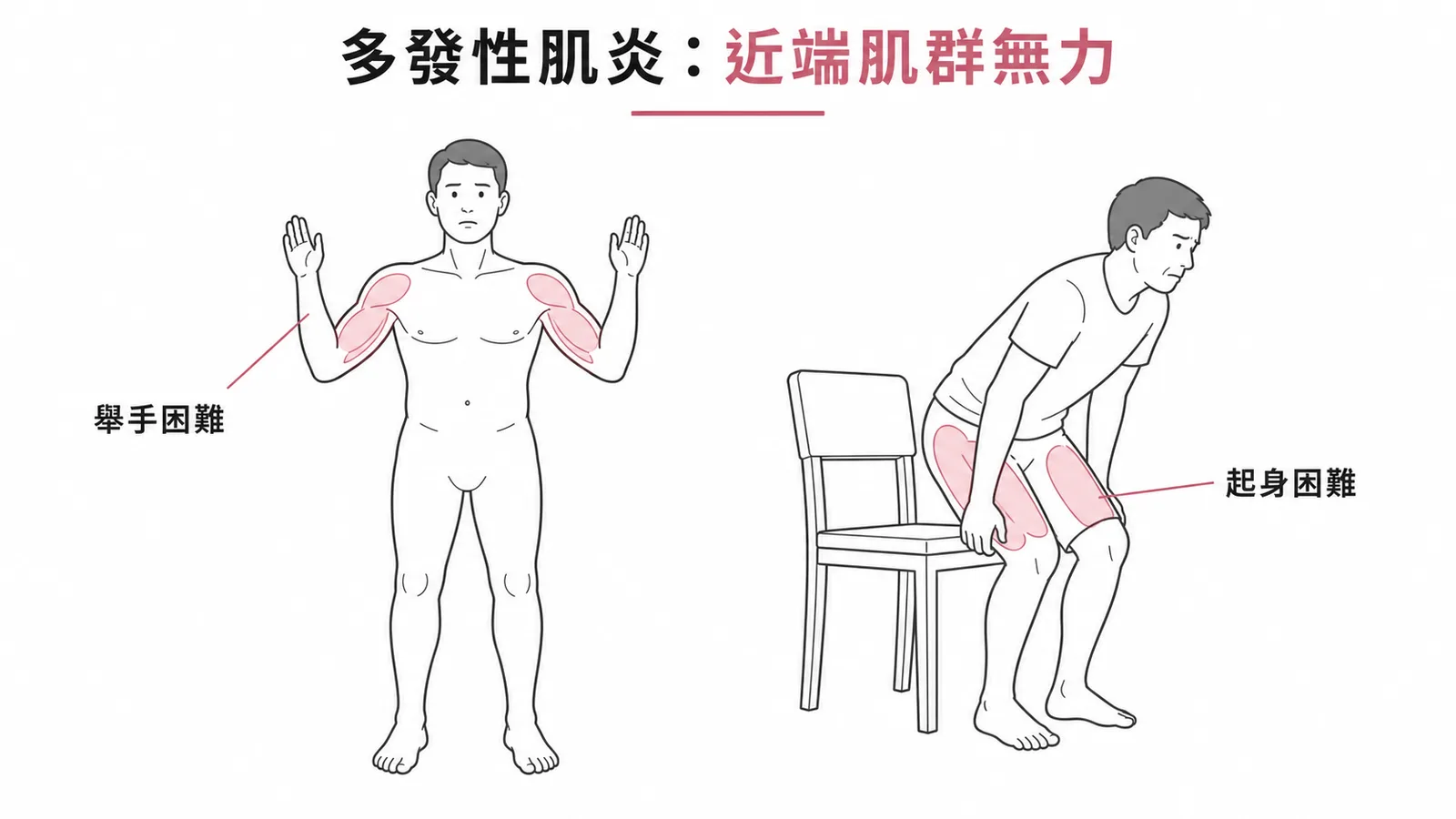 多發性肌炎近端肌群無力示意:舉手困難與起身困難