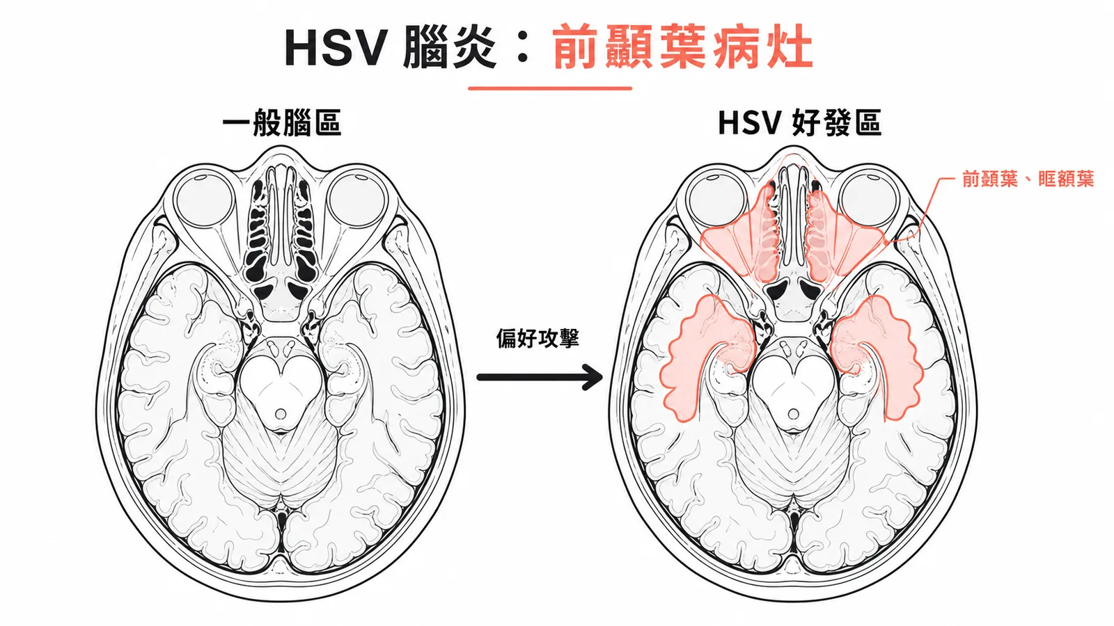 HSV腦炎典型MRI病灶:前顳葉與眶額葉受損區域