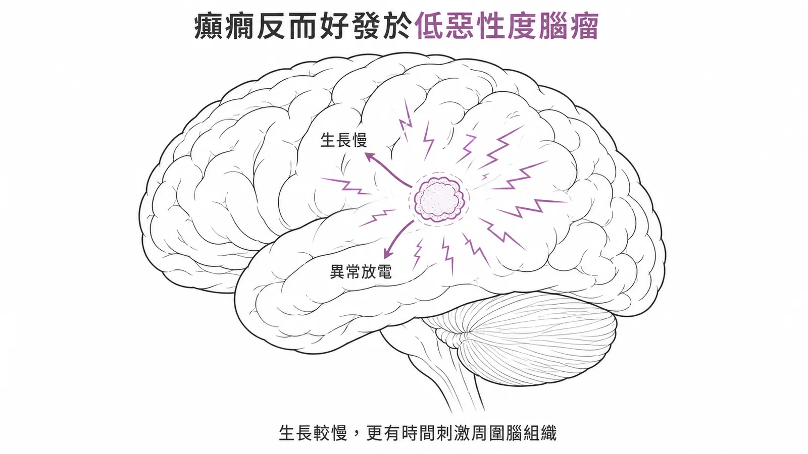 癲癇反而好發於低惡性度腦瘤:生長慢有時間刺激周圍腦組織異常放電