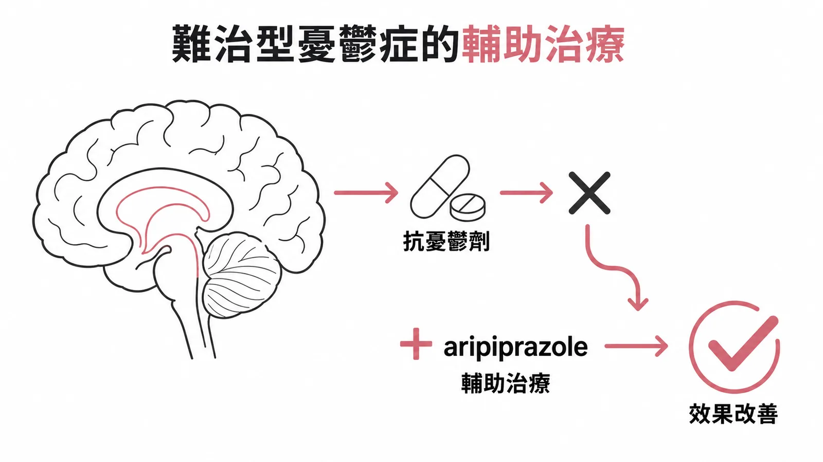 難治型憂鬱症輔助治療:抗憂鬱劑單用效果不佳時加上 aripiprazole 可改善療效