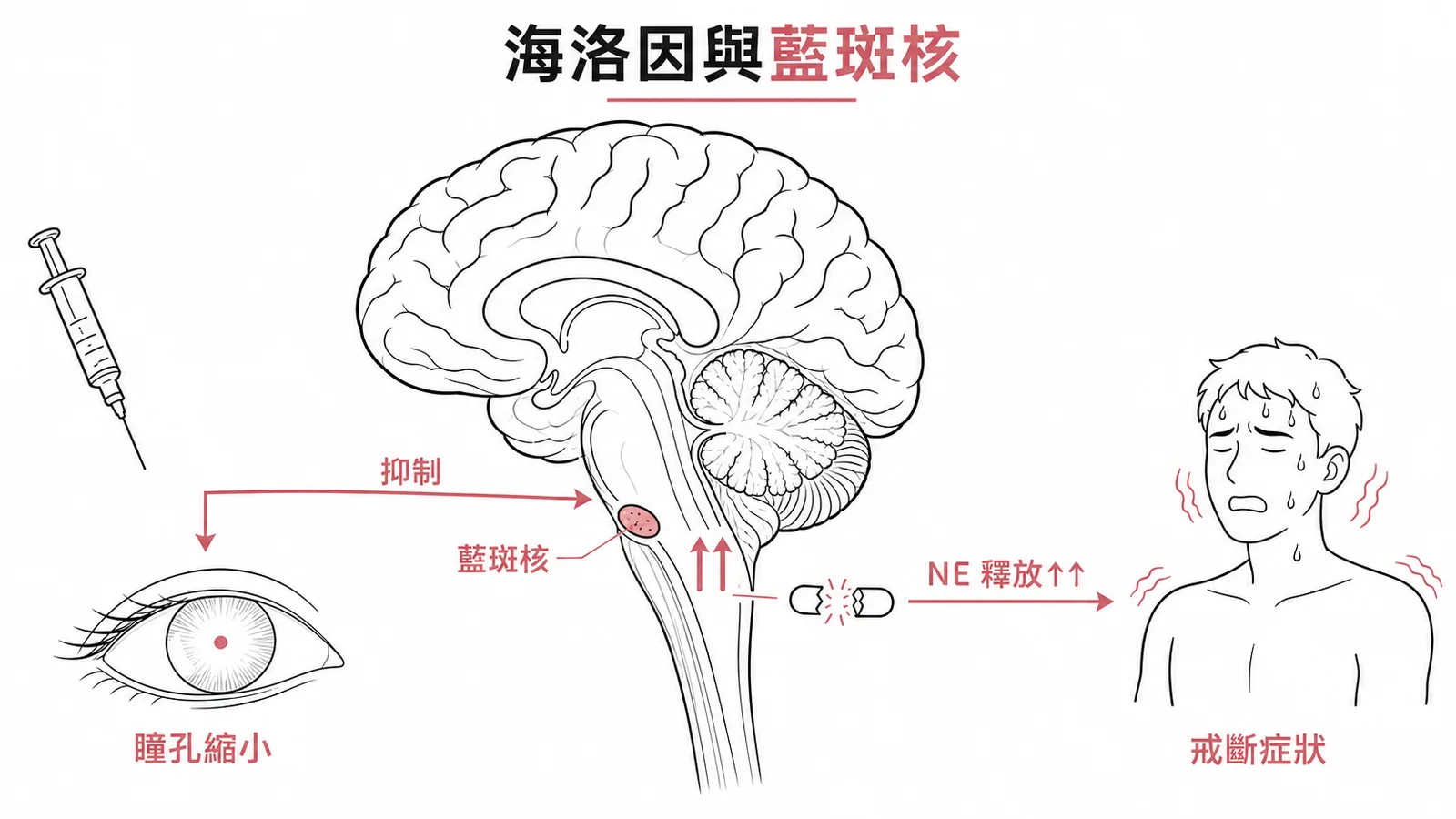 海洛因與藍斑核機轉:使用中抑制藍斑核致瞳孔縮小,戒斷時 NE 大量釋放引發交感過度興奮