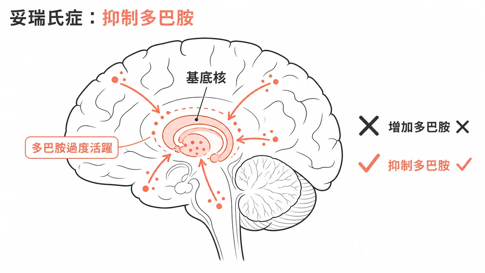 妥瑞氏症治療方向:抑制多巴胺而非增加