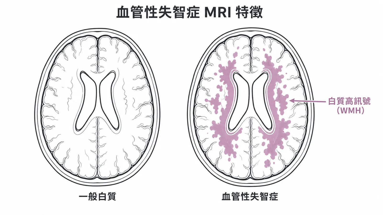 血管性失智症MRI特徵:腦室周圍與深部白質高訊號病灶