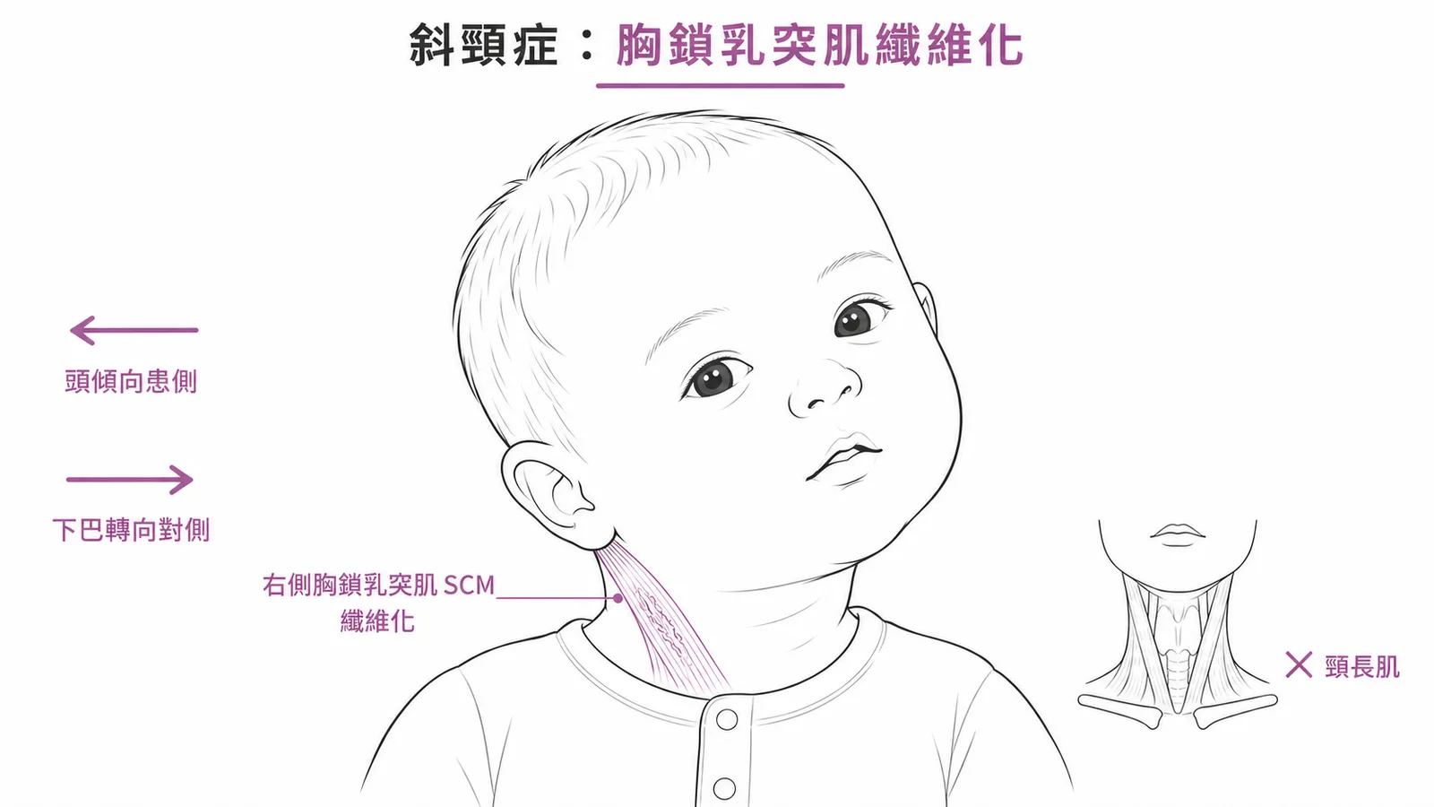 先天性肌肉性斜頸病變在胸鎖乳突肌纖維化而非頸長肌