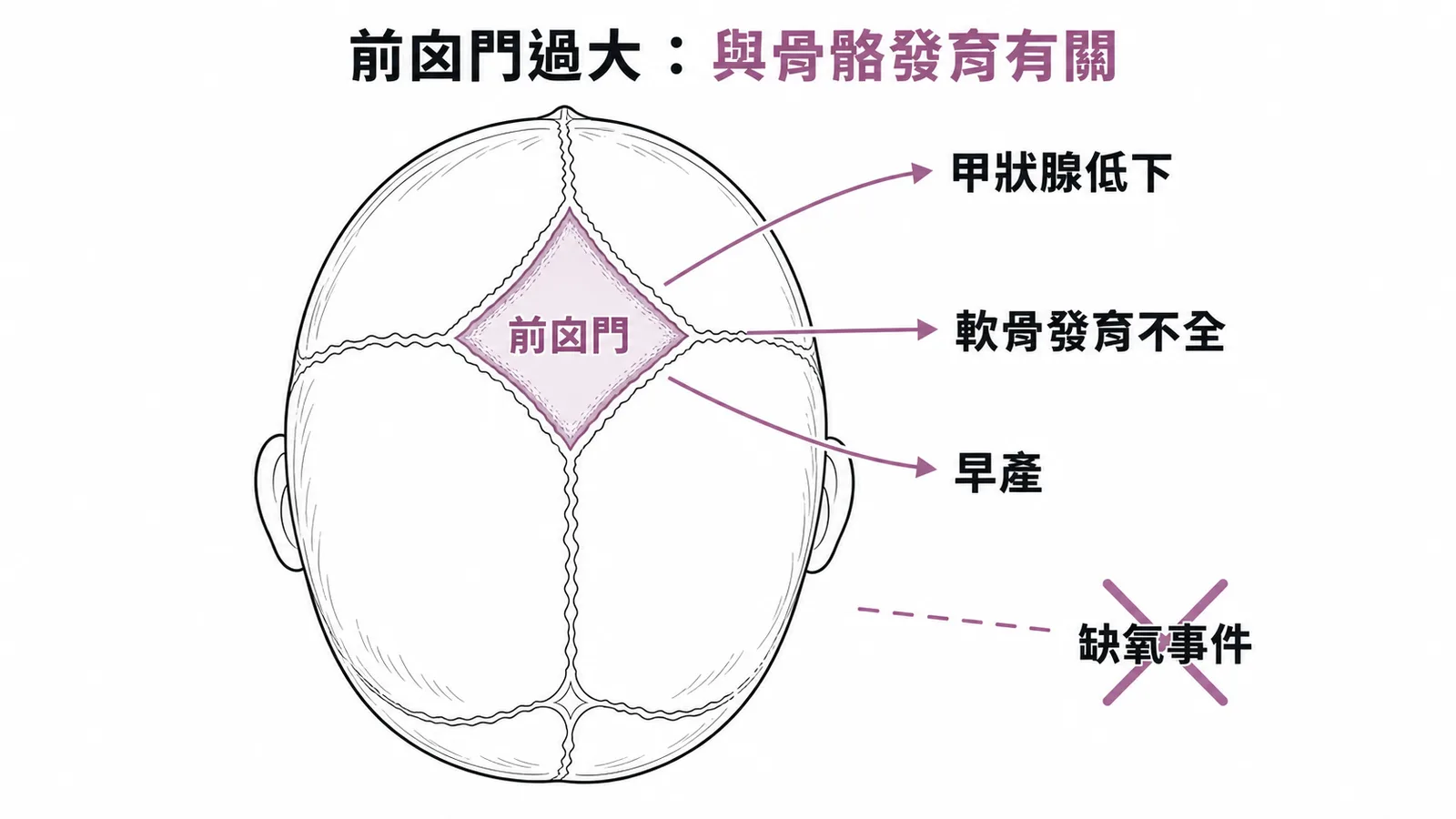 前囟門過大原因示意圖：骨骼發育相關 vs 缺氧事件無關