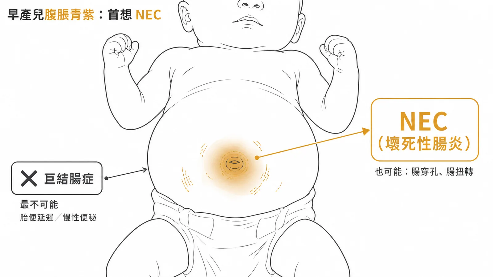 早產兒急腹症鑑別：NEC 最可能，巨結腸症最不可能