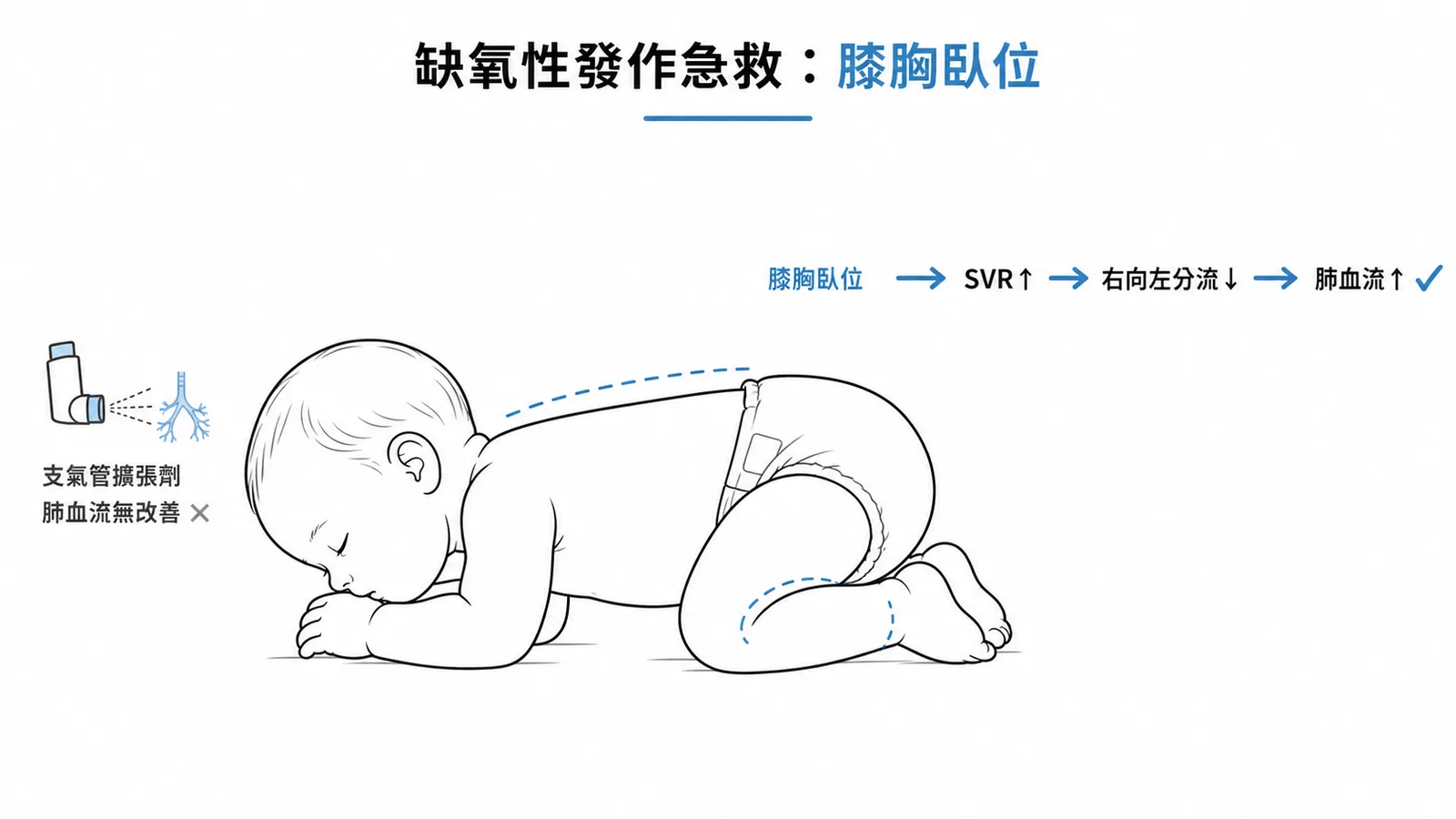法洛氏四重症缺氧性發作急救：膝胸臥位增加SVR減少右向左分流，支氣管擴張劑無效