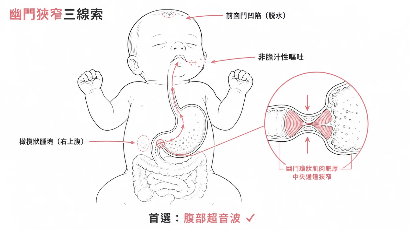 嬰兒肥厚性幽門狹窄三線索：非膽汁性嘔吐、右上腹橄欖狀腫塊、前囟門凹陷，首選腹部超音波