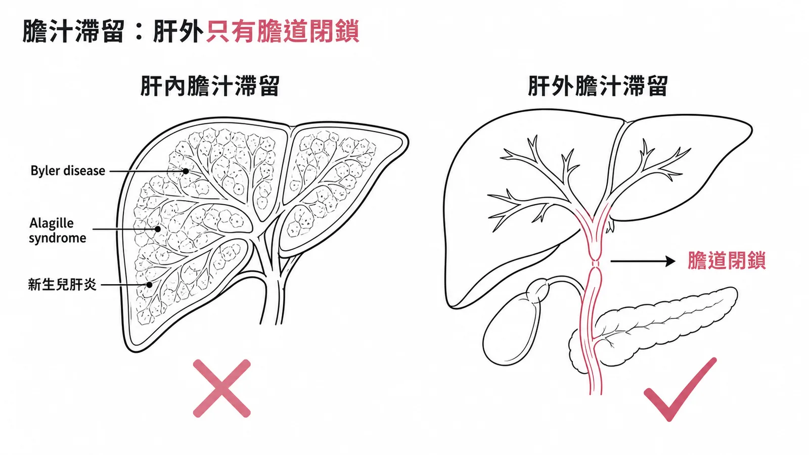 嬰兒膽汁滯留分類：肝外只有膽道閉鎖，其餘如Byler disease、Alagille syndrome、新生兒肝炎皆為肝內