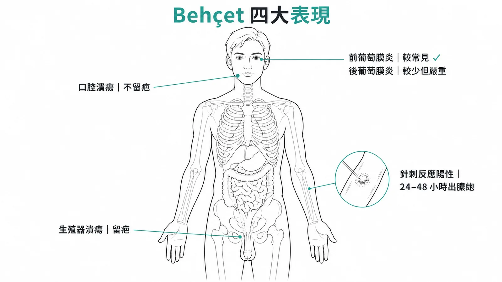 Behçet disease四大表現:口腔潰瘍不留疤、前葡萄膜炎較常見、生殖器潰瘍留疤、針刺反應陽性