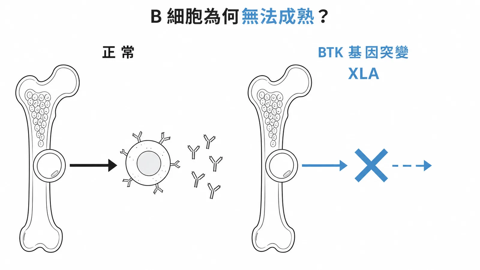 Bruton氏無乳球蛋白血症：正常B細胞發育與XLA的BTK基因突變阻斷對照