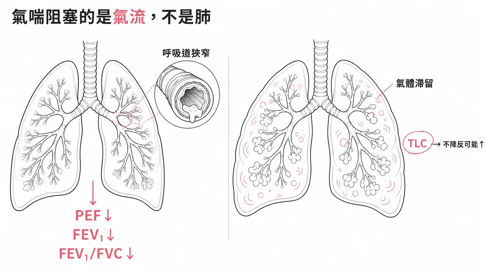 氣喘急性發作：氣流指標下降但肺總容量不降反升