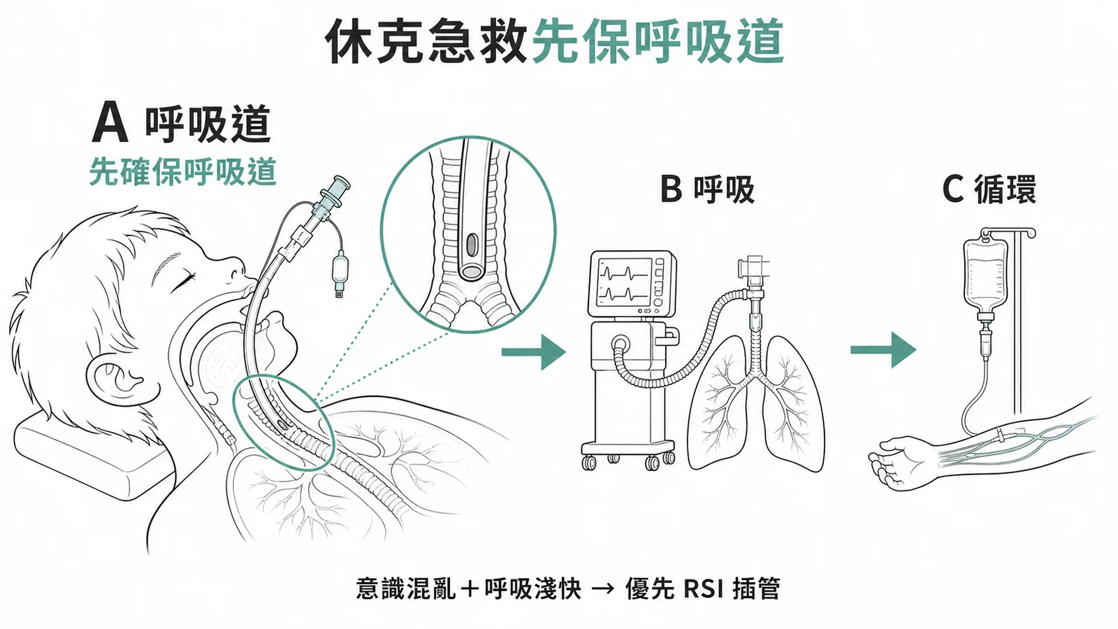 兒童休克急救ABCDE原則：意識混亂加呼吸淺快時優先確保呼吸道
