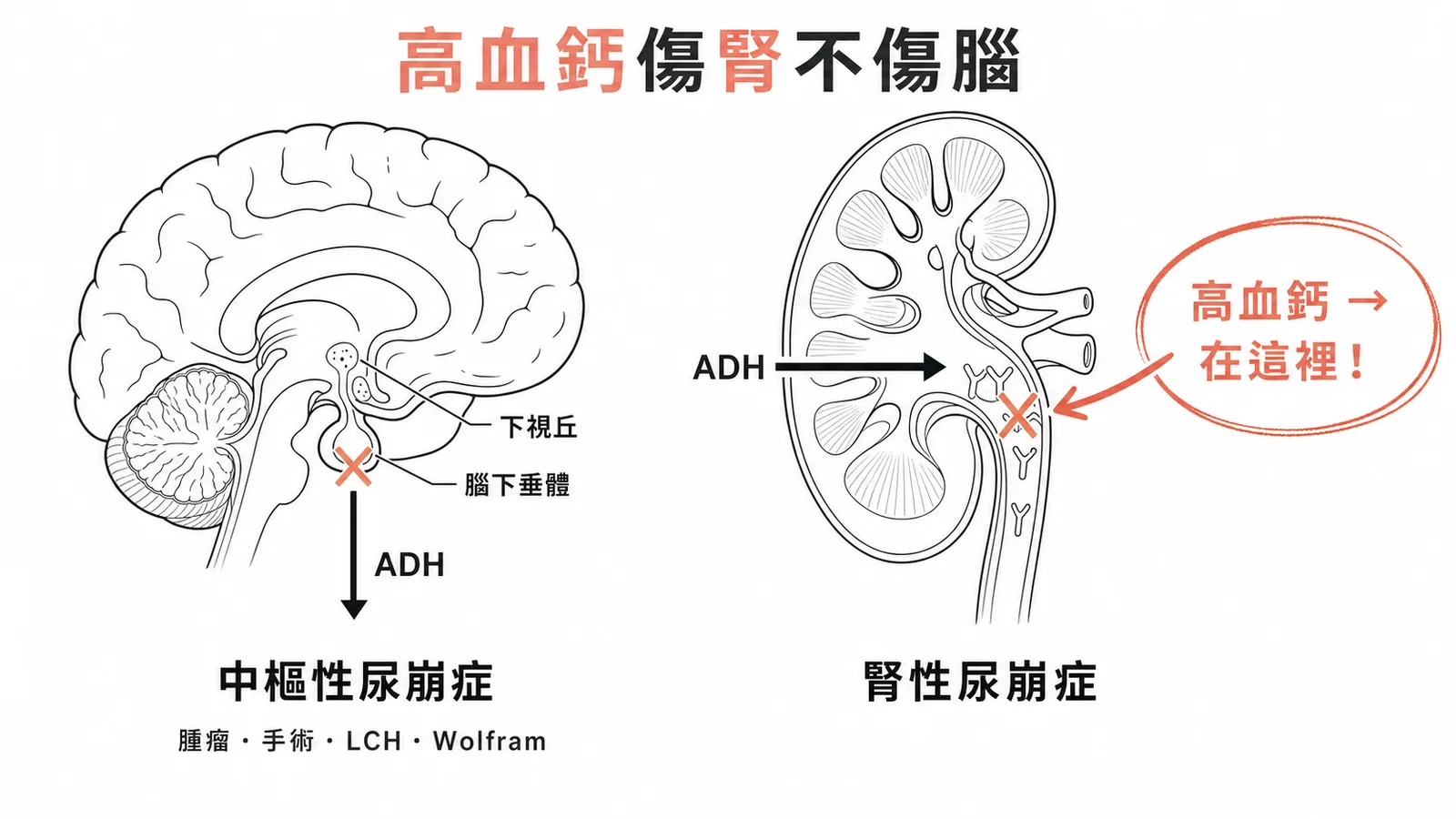 中樞性vs腎性尿崩症：高血鈣造成腎性尿崩症而非中樞性