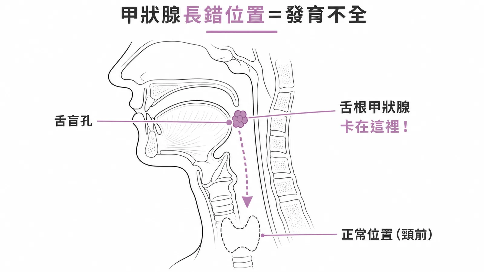 舌根甲狀腺：甲狀腺胚胎下降途中卡住屬於發育不全