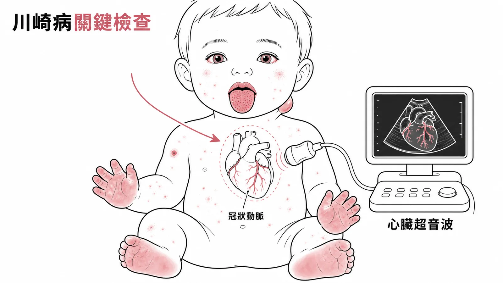 川崎病關鍵檢查：心臟超音波評估冠狀動脈