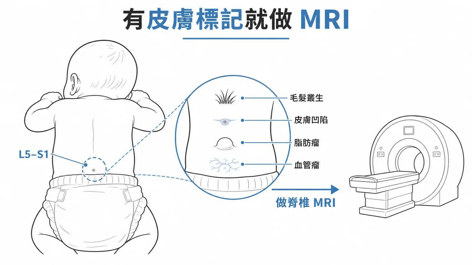 隱性脊柱裂：有皮膚標記就做脊椎MRI