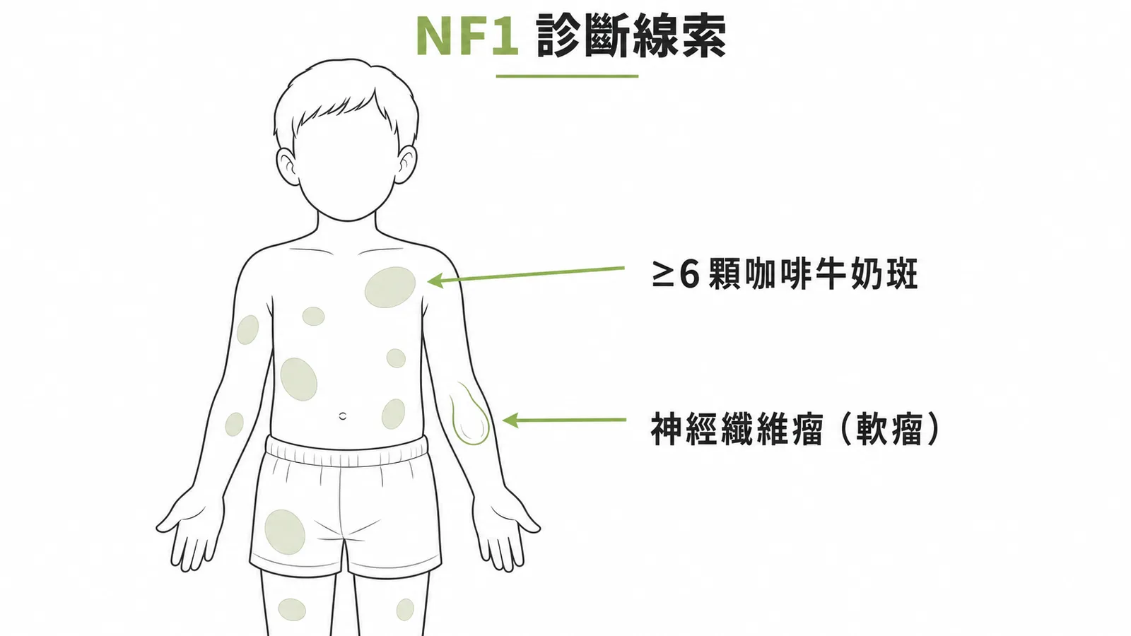 NF1診斷線索：多發咖啡牛奶斑與神經纖維瘤