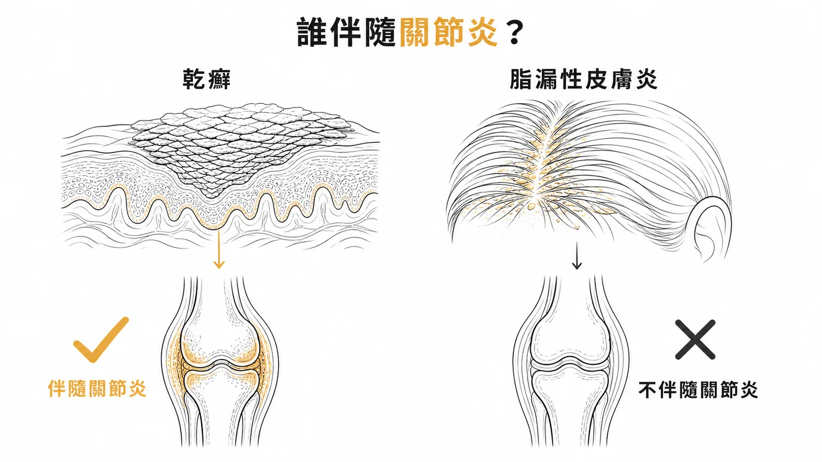 乾癬伴隨關節炎而脂漏性皮膚炎不會
