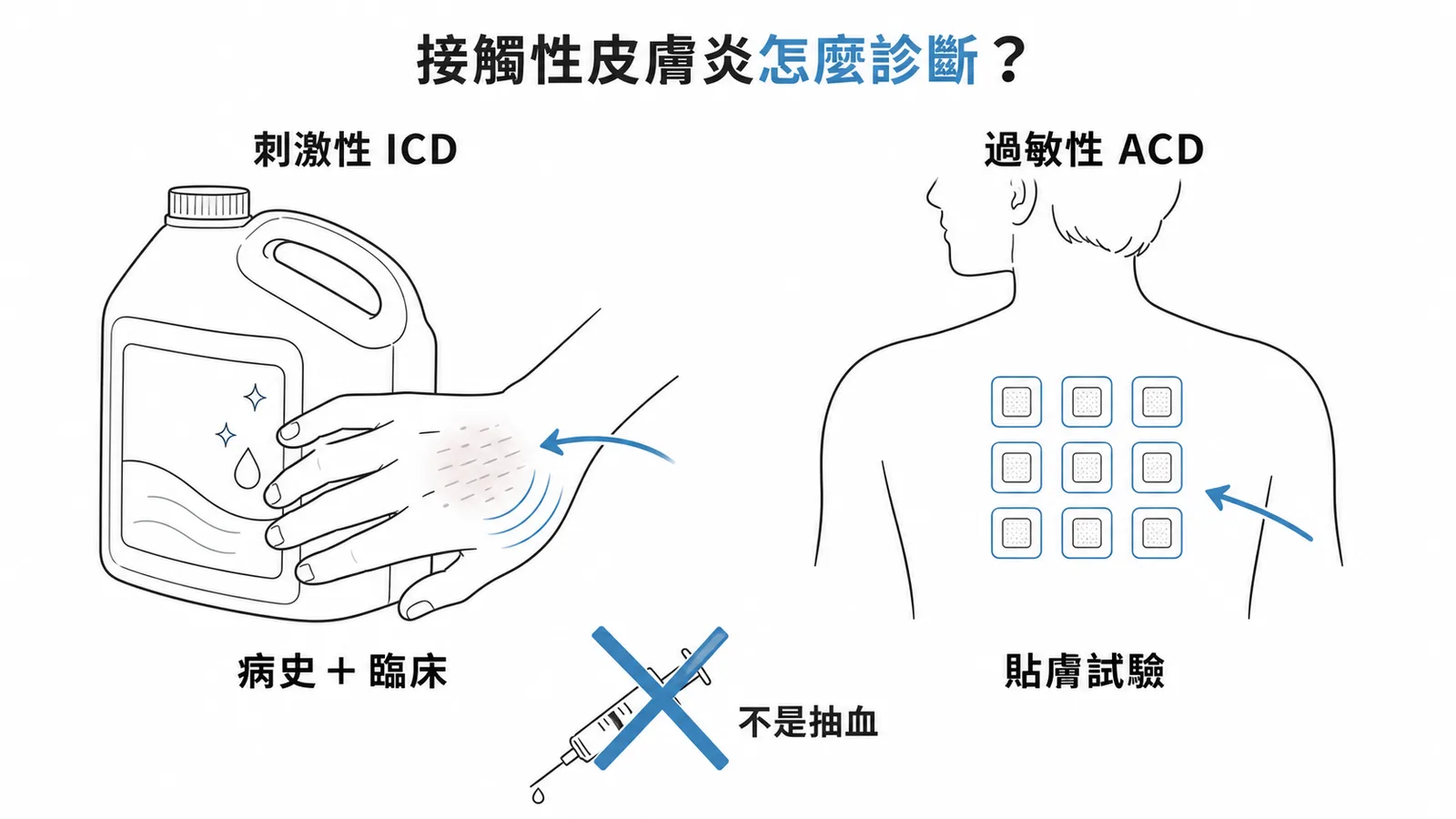 接觸性皮膚炎診斷:ICD靠病史臨床、ACD靠貼膚試驗、不是抽血