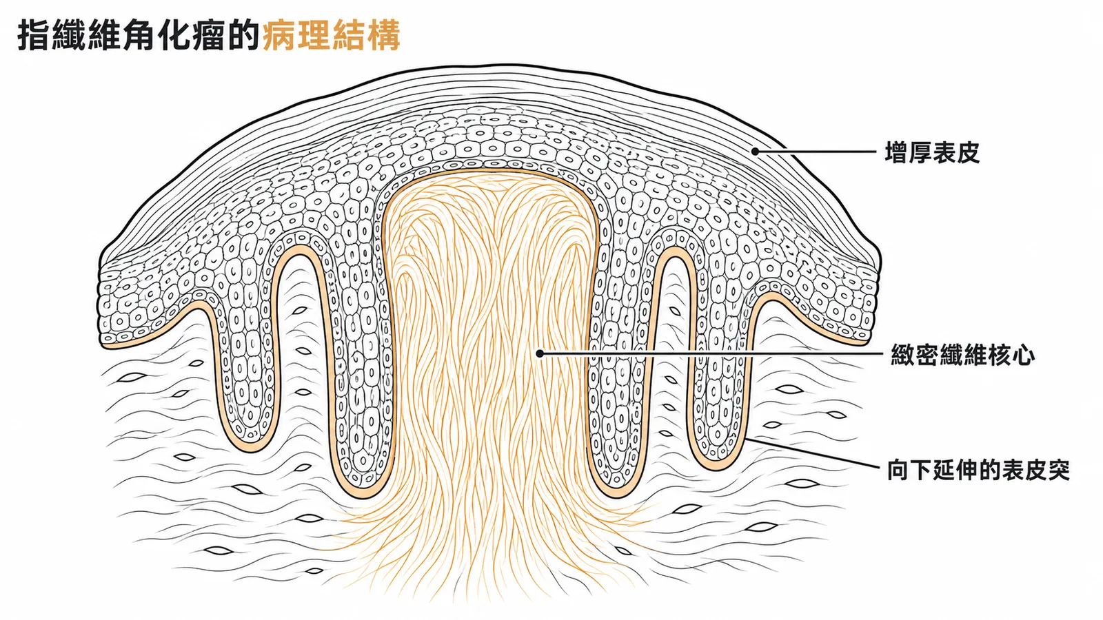 後天性指纖維角化瘤的病理結構：緻密纖維核心與增厚表皮