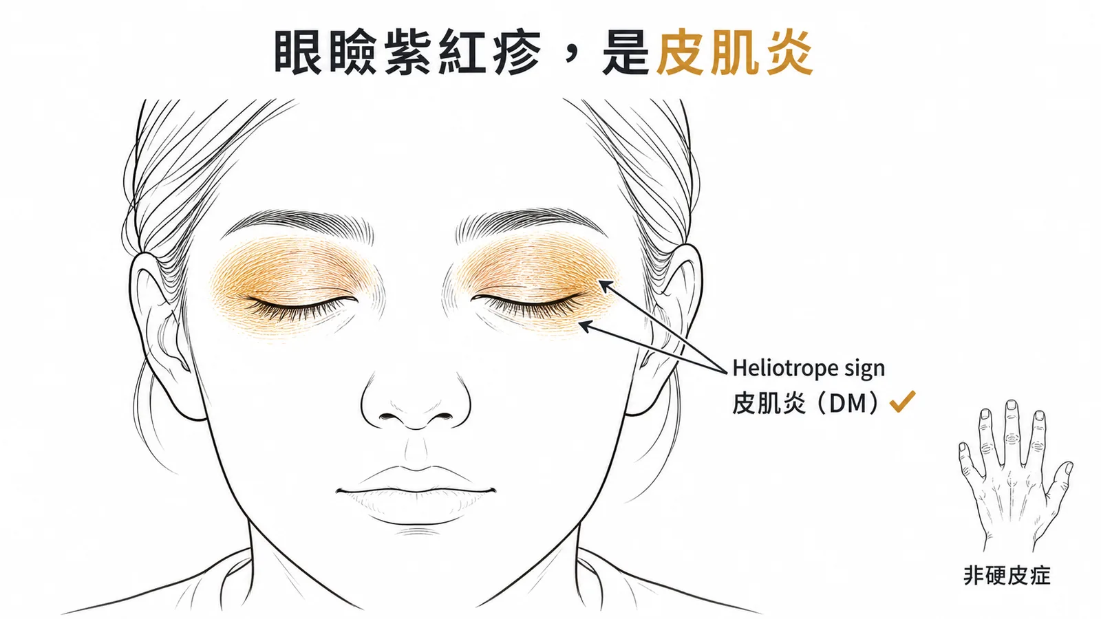 Heliotrope sign是皮肌炎的眼瞼紫紅色皮疹，非硬皮症