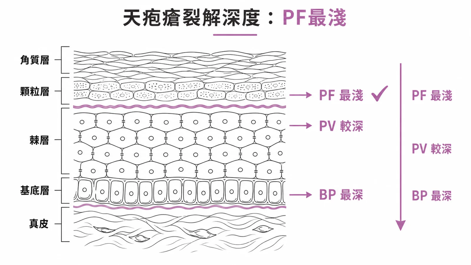 天疱瘡表皮裂解深度對照：PF顆粒層最淺、PV棘層、BP基底膜