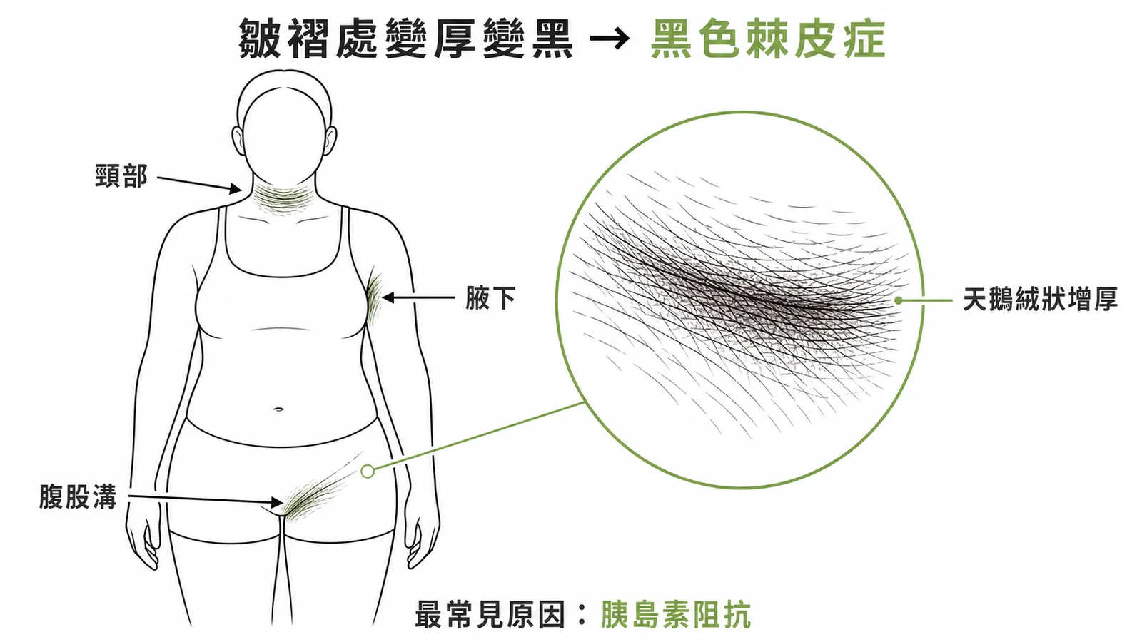 黑色棘皮症好發皺褶處,天鵝絨質地,最常見原因為胰島素阻抗