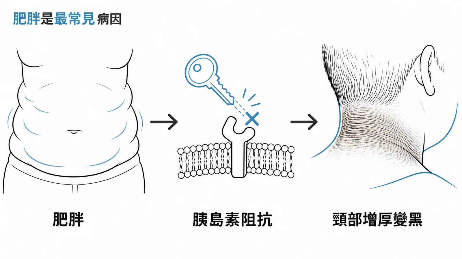 肥胖→胰島素阻抗→黑色棘皮症的致病機轉